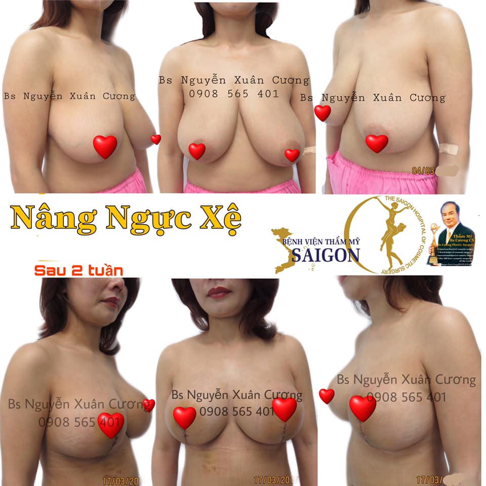 Nâng ngực xệ sau sinh