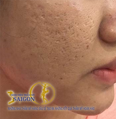 Spa trị sẹo rỗ với mức độ nặng dứt điểm mà các nơi khác không làm được.