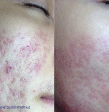 Trị sẹo rỗ lâu năm do dùng sai mỹ phẩm hoặc biến chứng thẩm mỹ