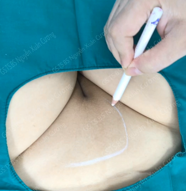 Ở thành phố Hồ Chí Minh có một Bác sĩ cấy lông âm mu đẹp tự nhiên