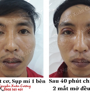 Thẩm mỹ viện chuyên điều trị bệnh sụp mí mắt