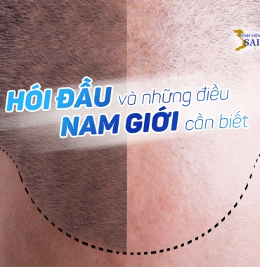 HÓI ĐẦU VÀ NHỮNG ĐIỀU NAM GIỚI CẦN BIẾT