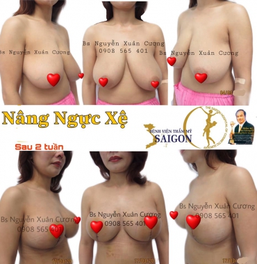 NÂNG NGỰC CHÃY XỆ _ NÂNG NGỰC SA TRỄ