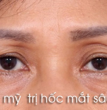 Phẩu thuật trị hốc mắt sâu bằng phương pháp cấy mỡ tự thân